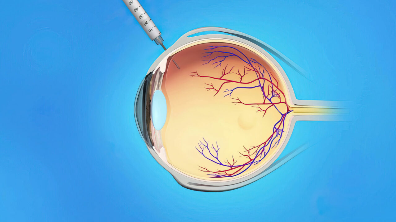 ANTI-VEGF u liječenju dijabetičke retinopatije