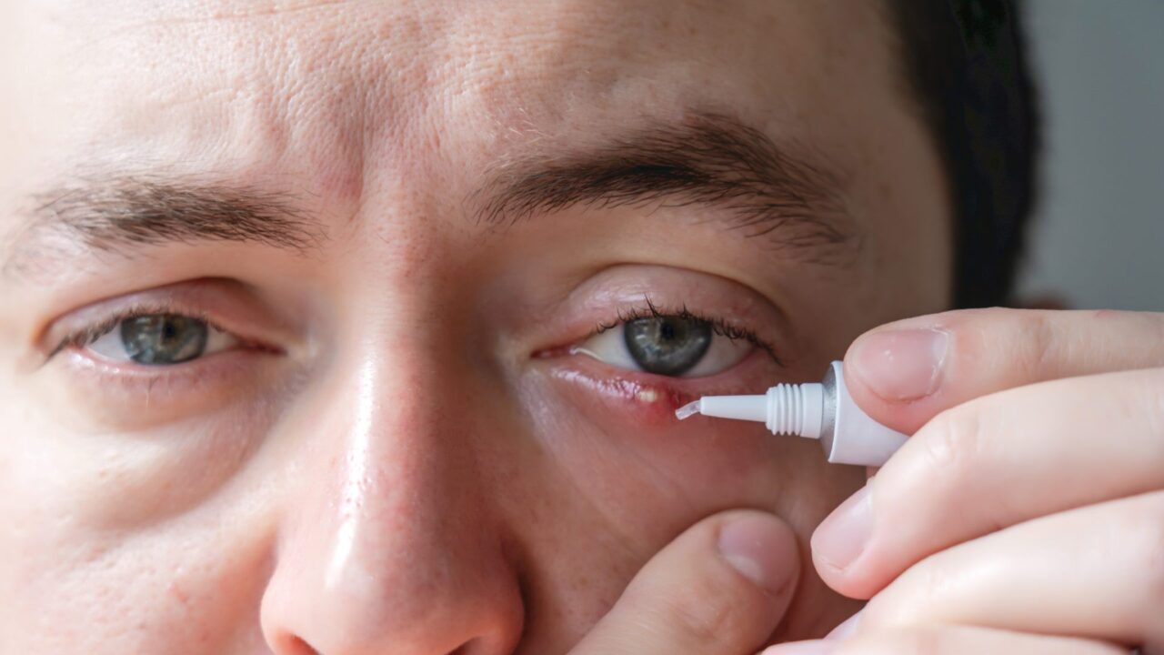 Što je ječmenac i kako se liječi?