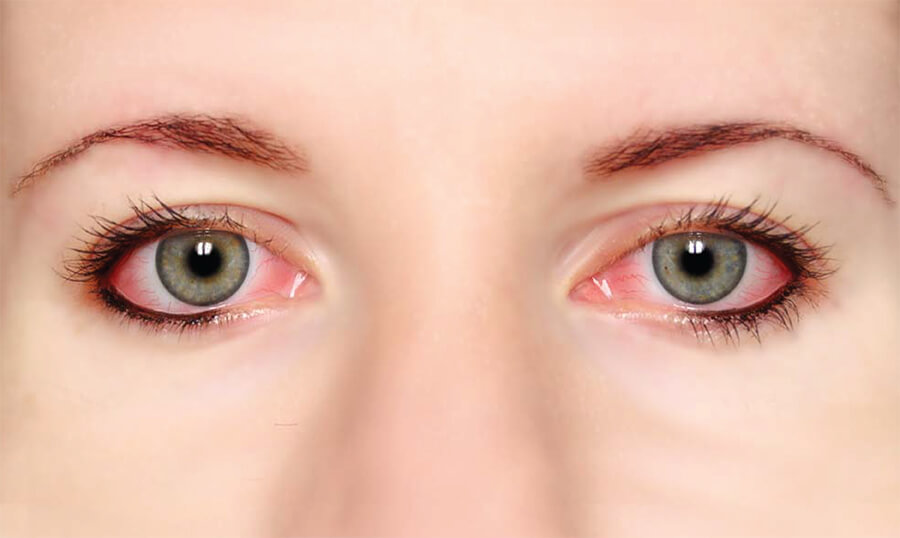 Kako tretirati očne alergije