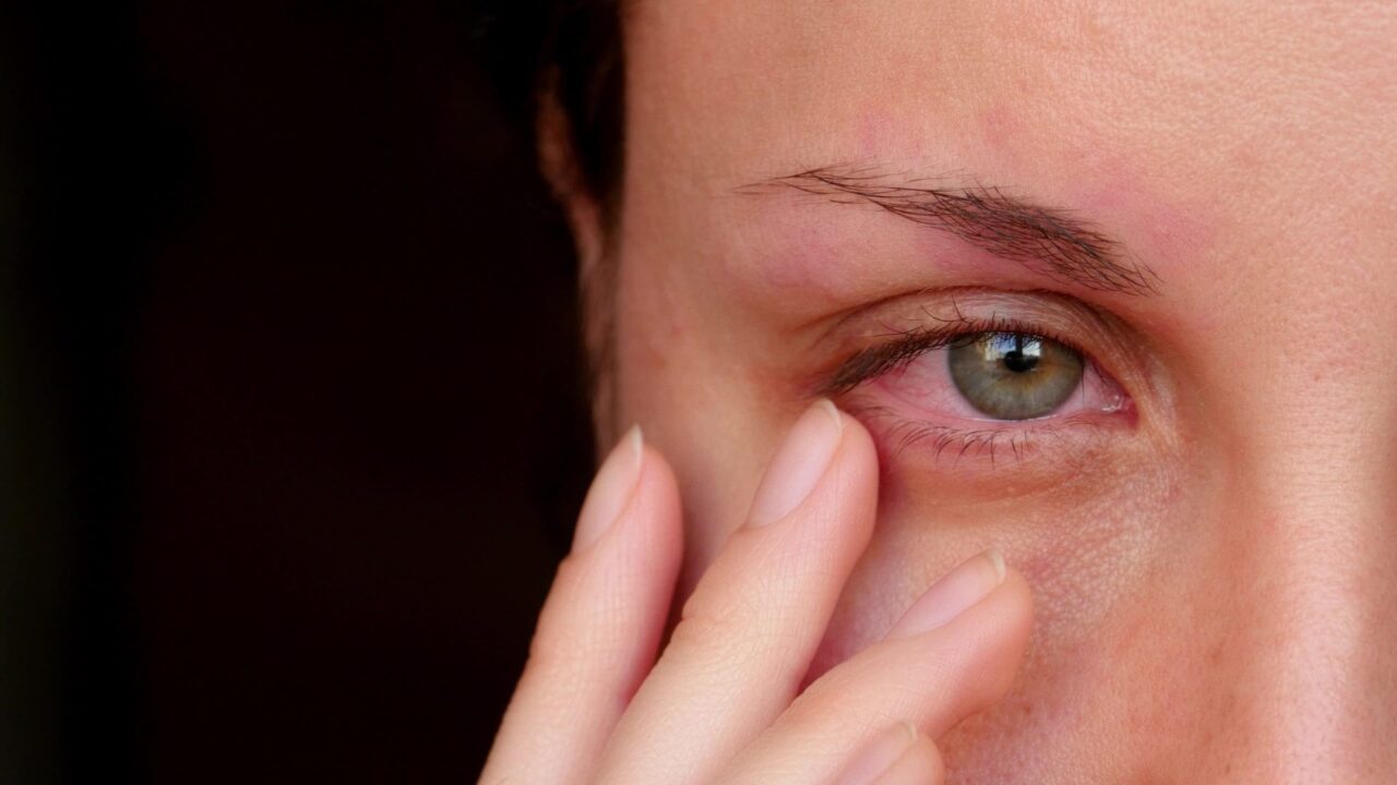 Suho oko ili alergija? Kako razlikovati i zašto je razlika važna
